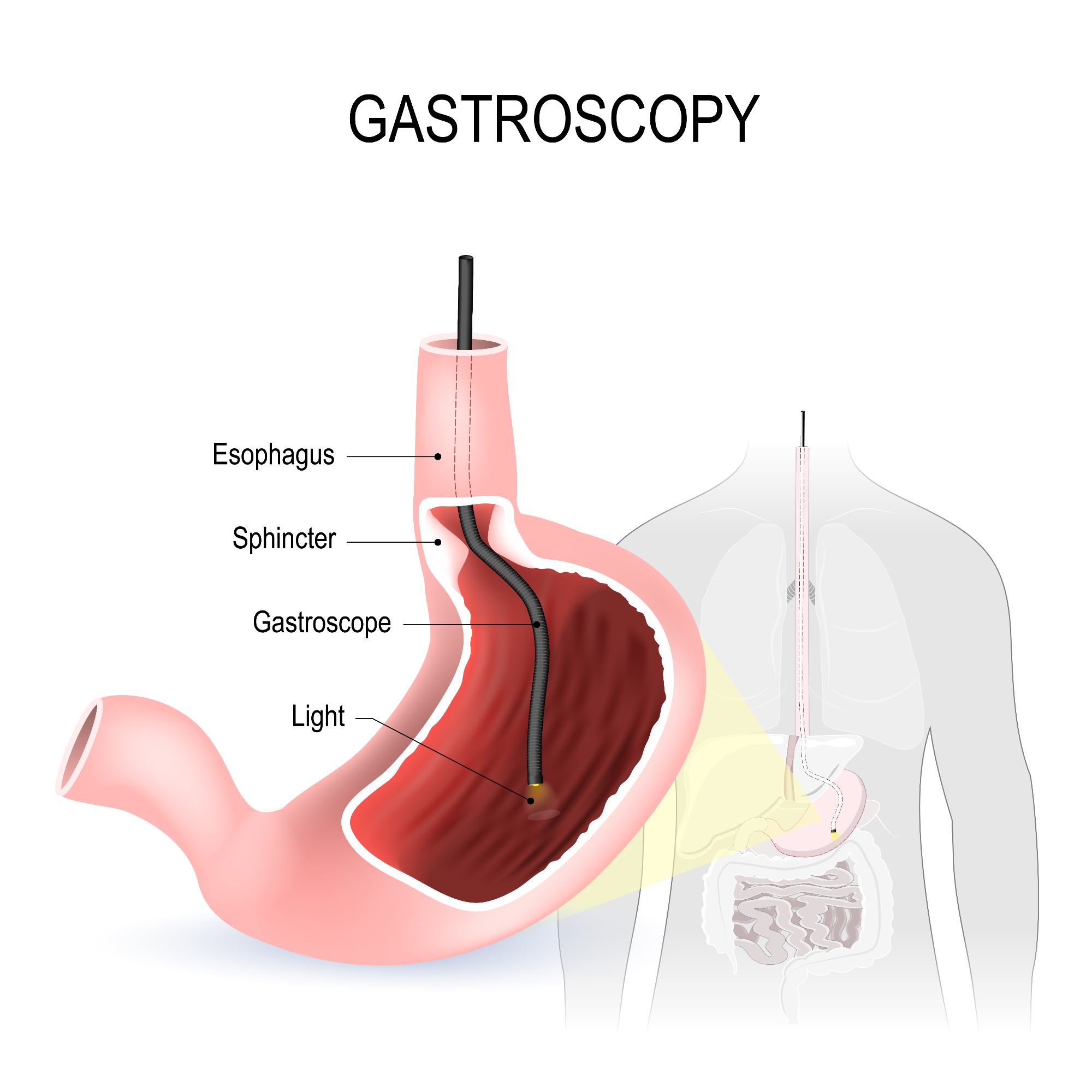 Vse, kar morate vedeti o samoplačniški gastroskopiji